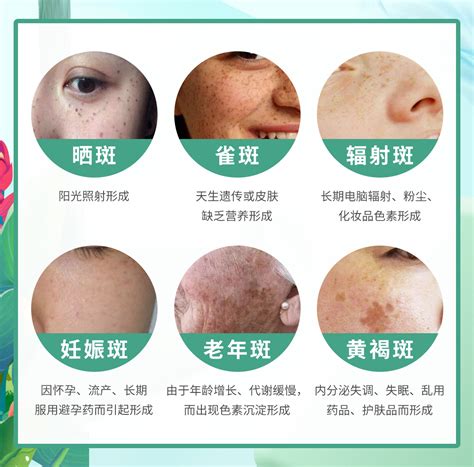 臉上黑斑|黑斑 (Melasma)